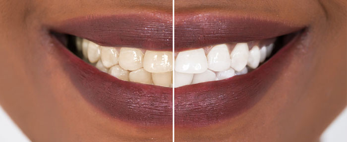 Teeth Whitening, OgaDentist